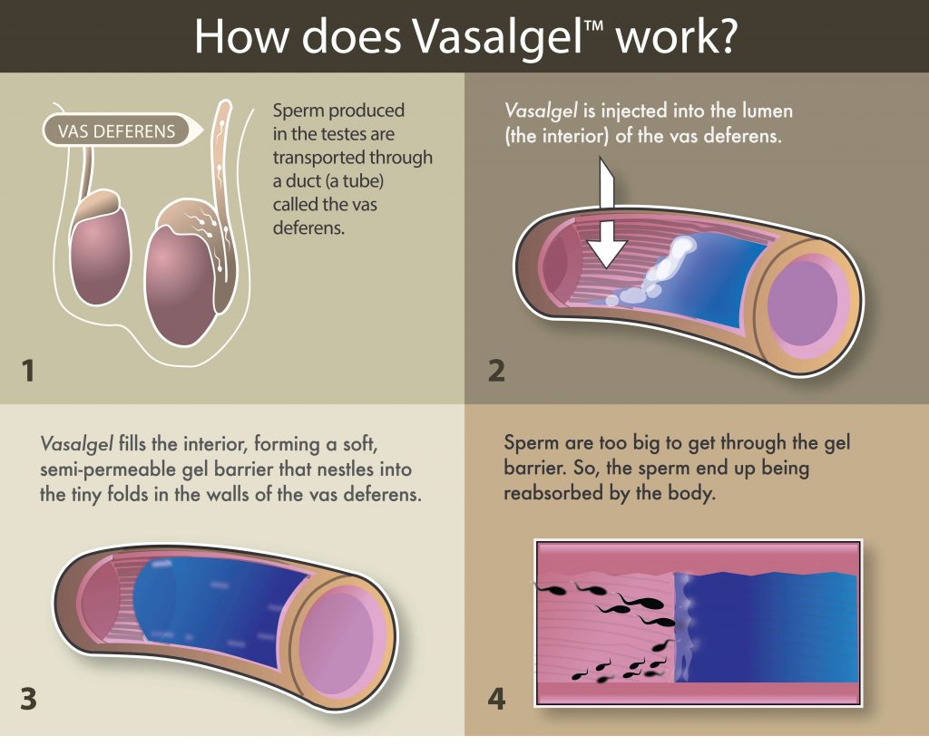vasalgel male contraceptive vasectomy gel