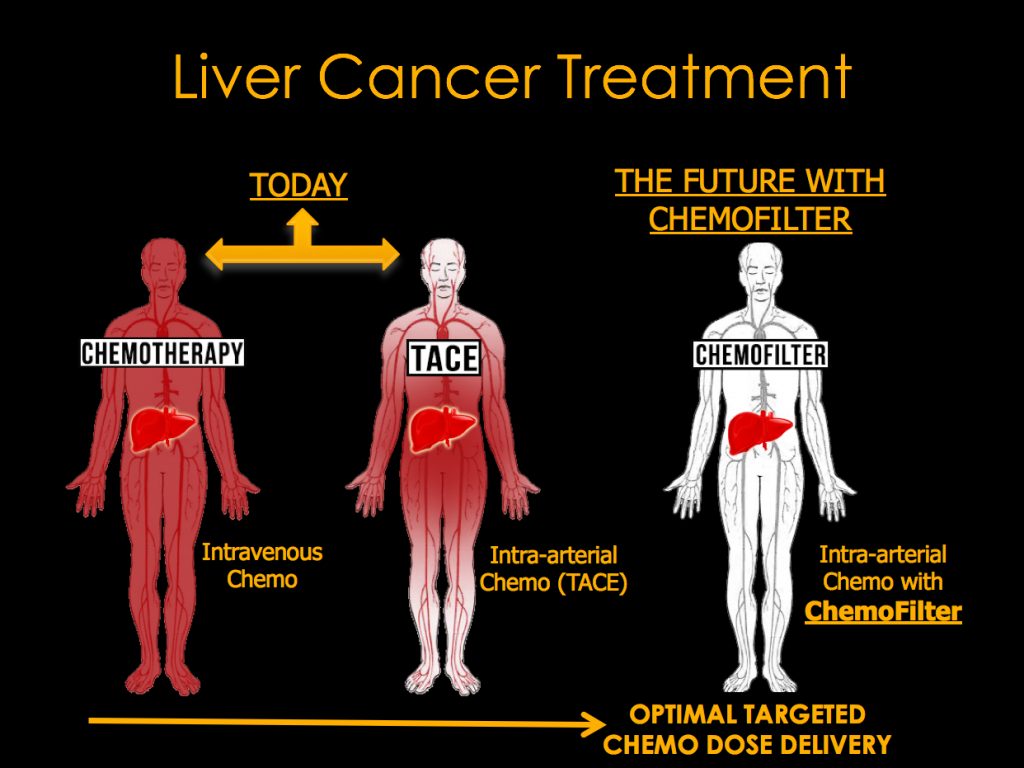 The chemotherapy sponge "chemofilter" stops chemotherapy drugs spreading throughout the body causing harm