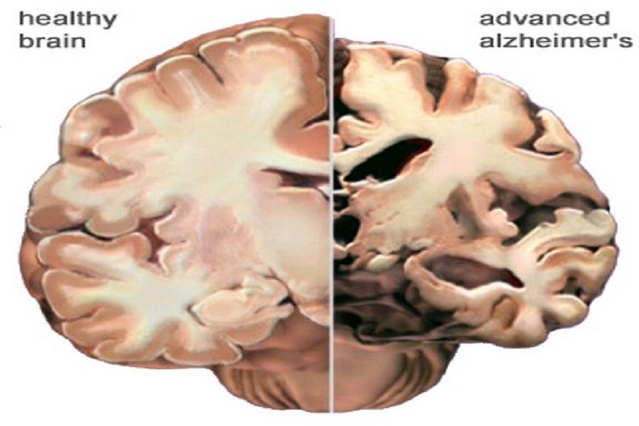 Advanced alzheimer's brain
