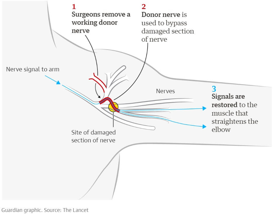 Nerve transfer surgrey restores hand and arm movement in 13 young adults