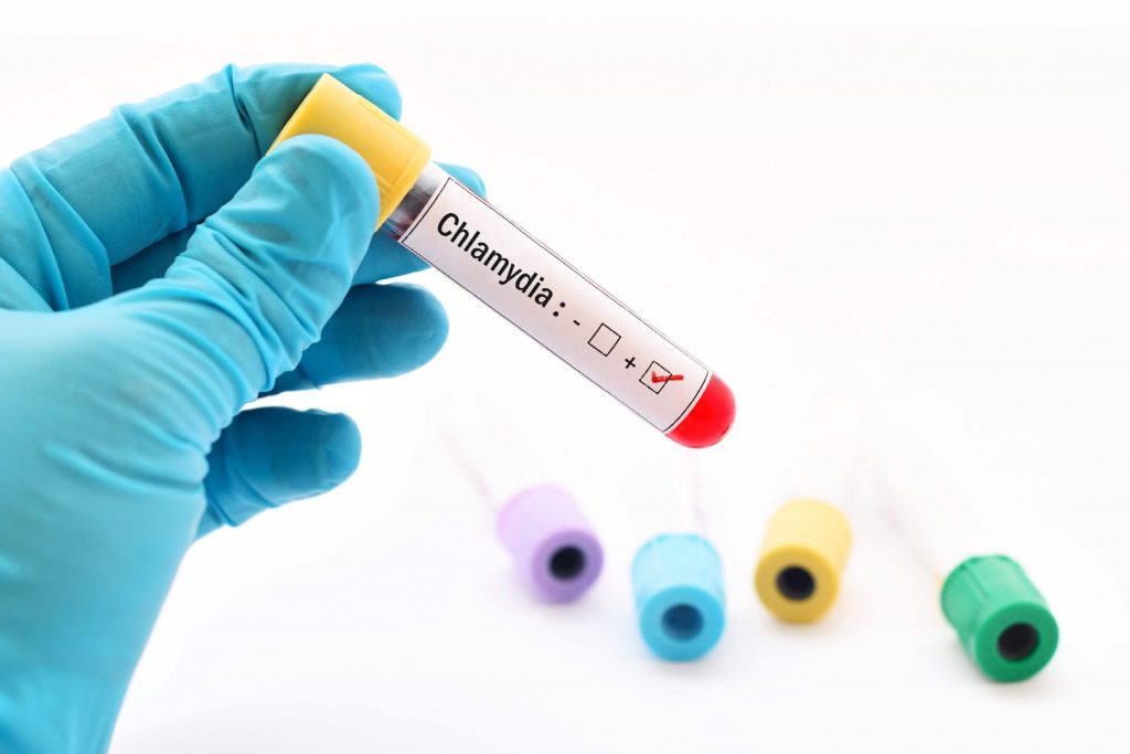chlamydia test
