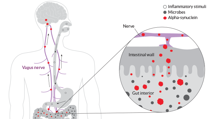 Bacteria In Gut Can Promote Parkinson's by Altering Brain's Immune Reactions