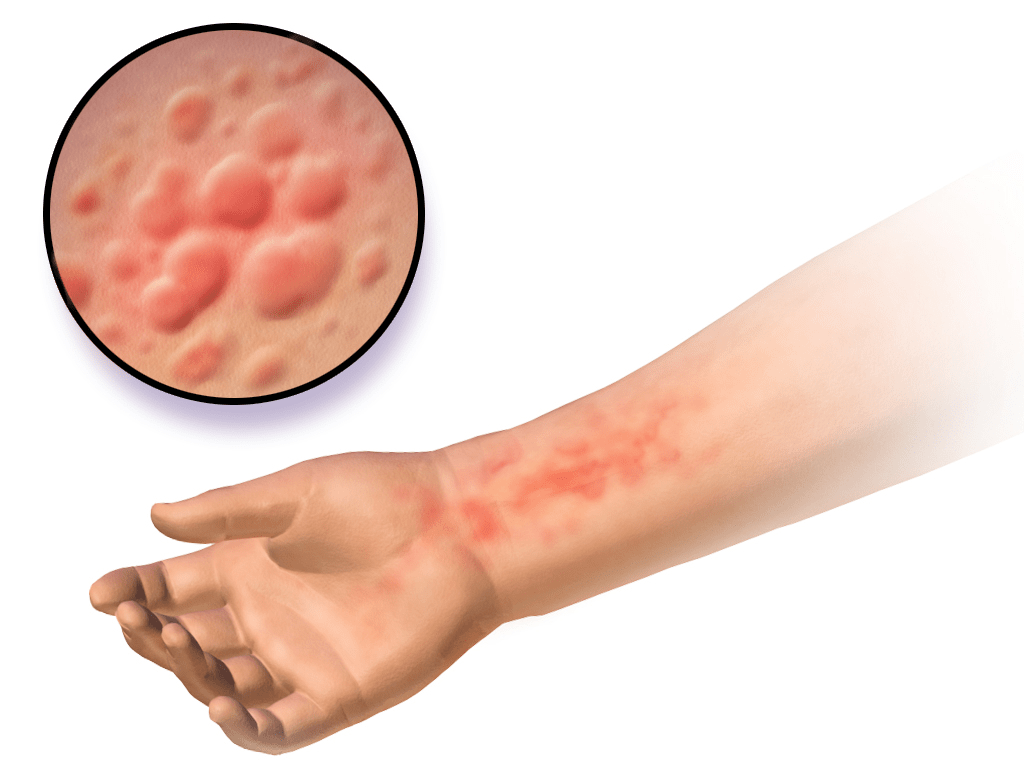 New drug shows promising results against eczema in priliminary human clinical trials