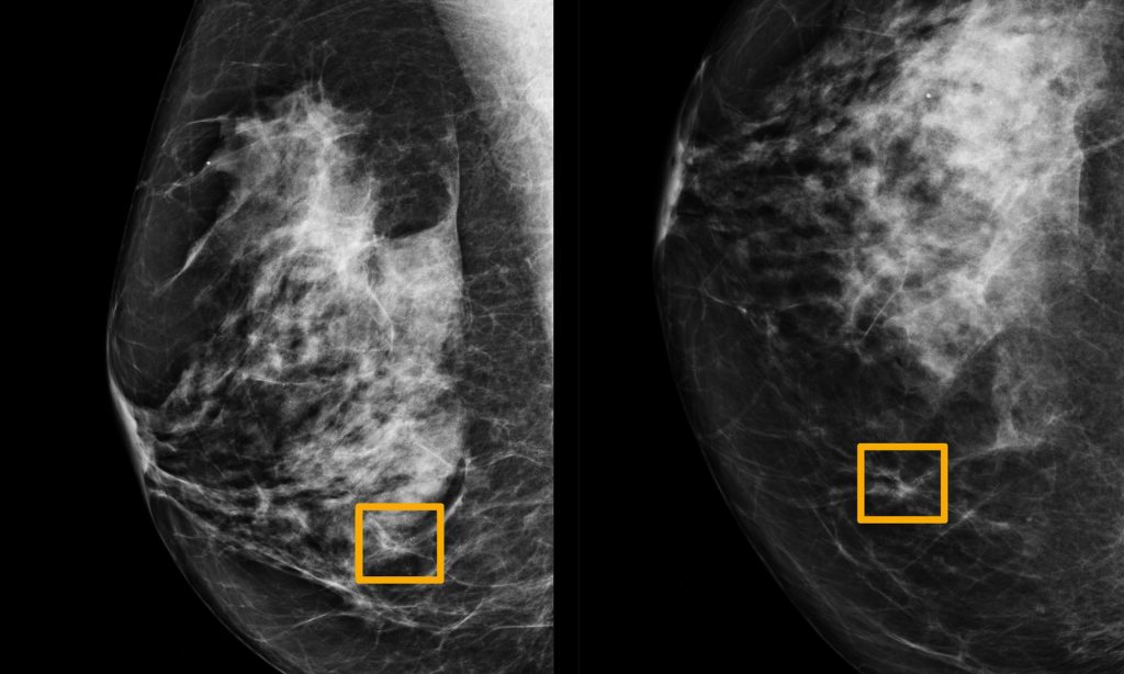 AI outperforms experts in spotting breast cancer