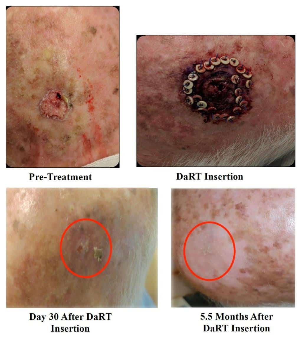 Deeply infiltrating SCC of the scalp with complete response noted at day 30.
