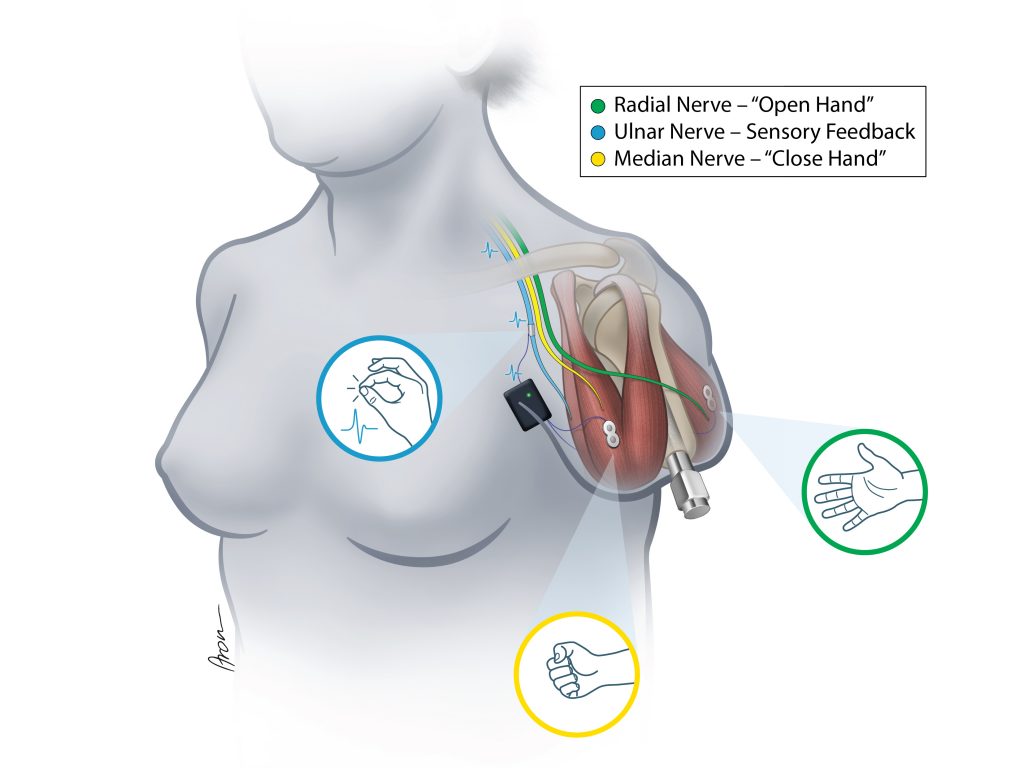 The interface with muscles and nerves. This diagram shows how the user can control the prosthesis with their mind