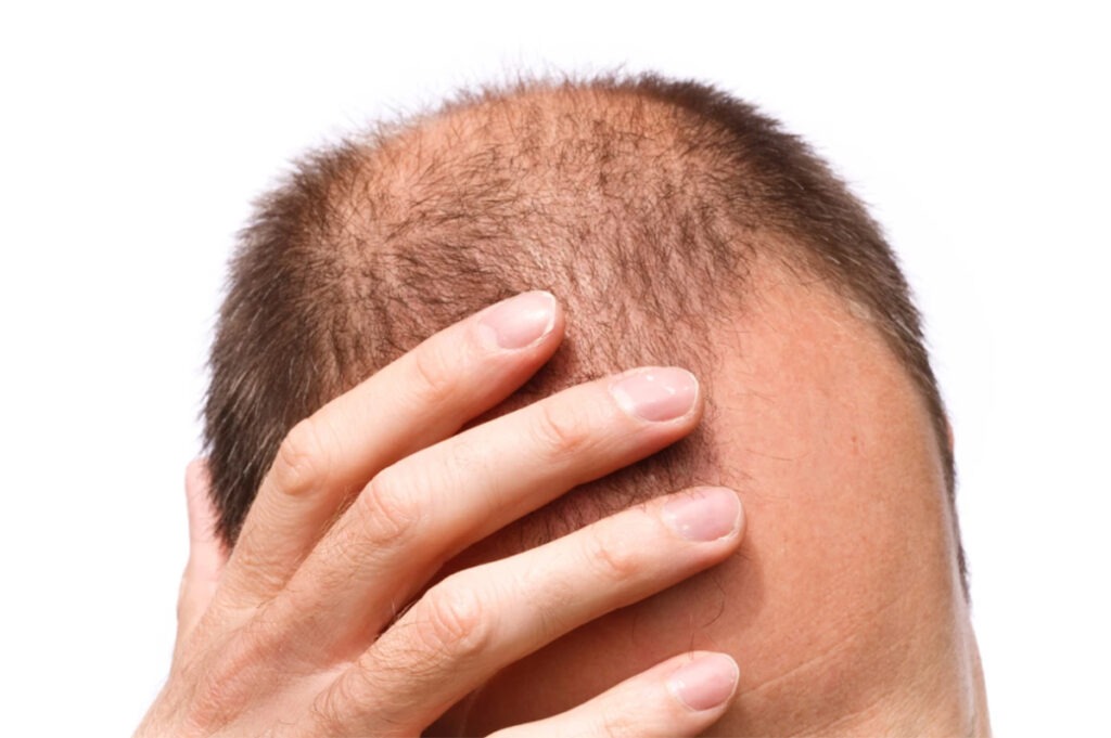 This New Topical Solution For Baldness Has Excellent Results