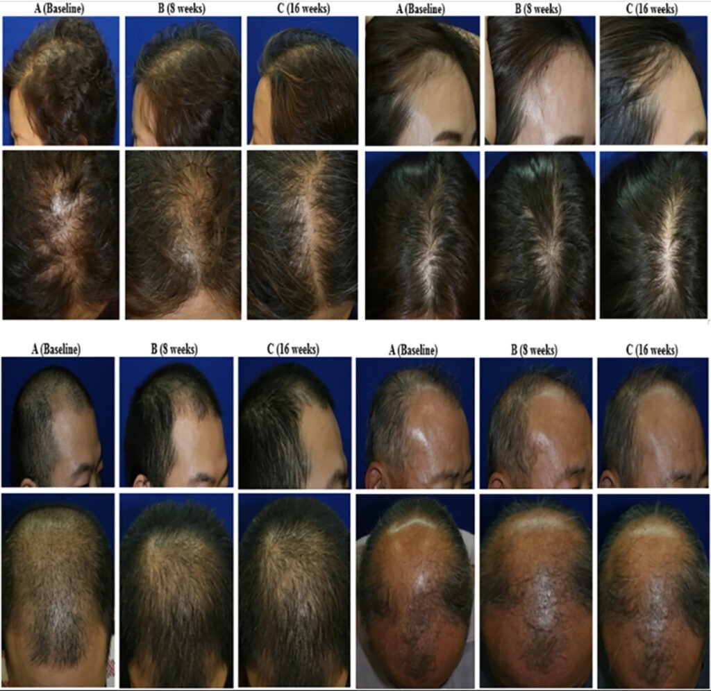 This New Topical Solution For Baldness Has Excellent Results