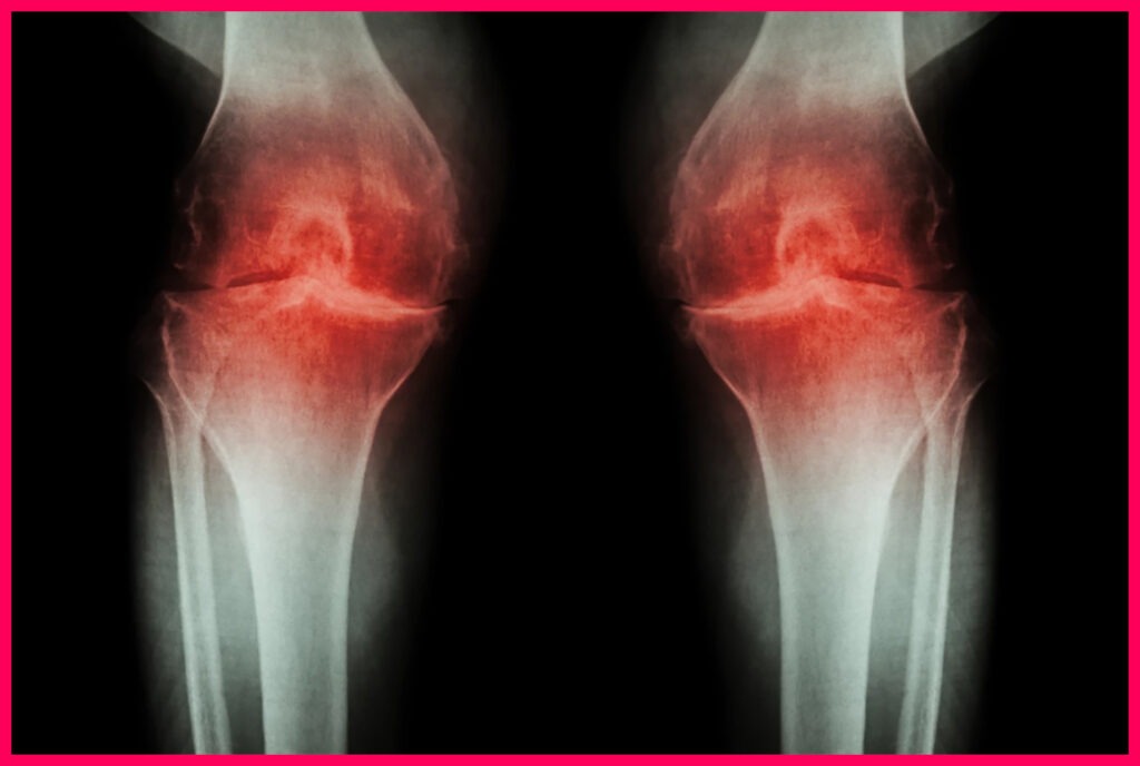 Scientists Regrow Joint Cartilage In Arthritic Mice By Altering Stem Cells