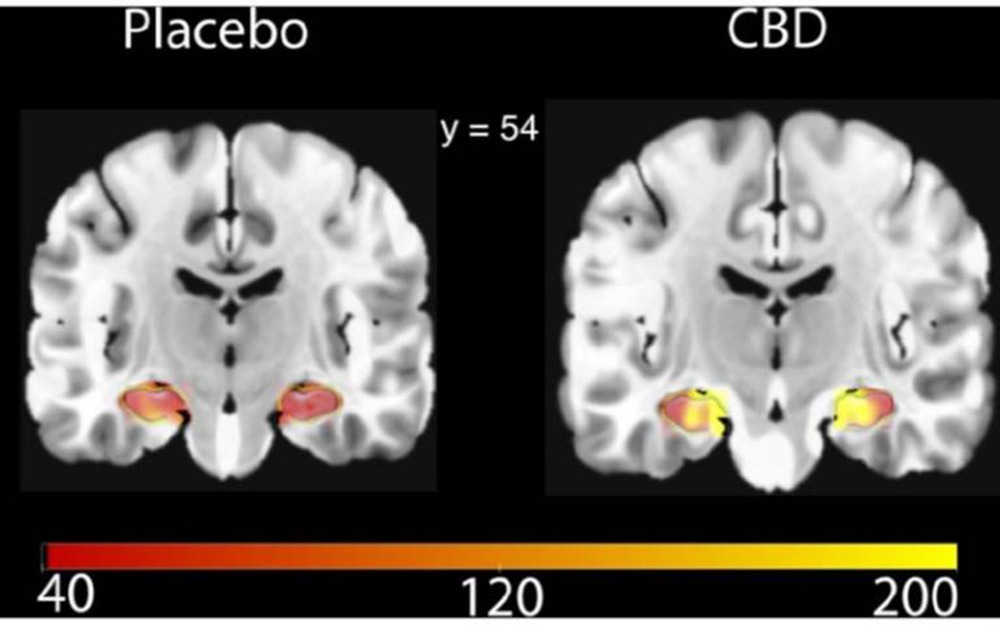 A Single Dose of CBD Improves Cerebral Blood Flow