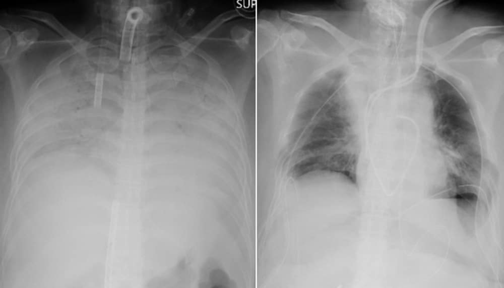 A COVID-19 Patient Receives A Living Donor Lung Transplant, A World-First Surgery
