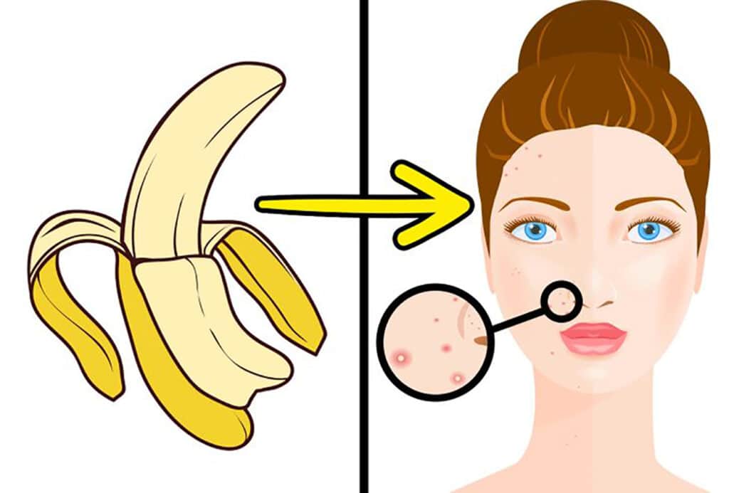 Use banana peels to reduce acne