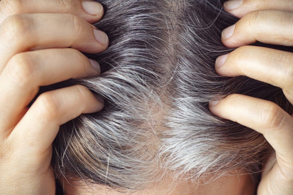 Gray Hair Can Revert Its Original Color When Stress Is Alleviated