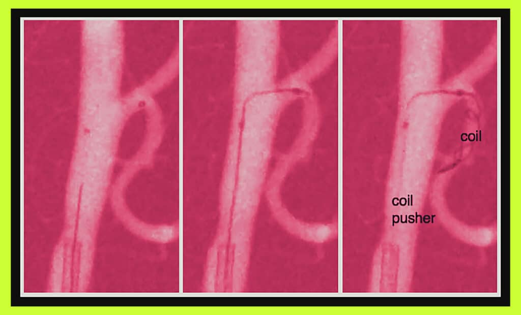 Insect-Inspired Steerable Catheter To Treat Hard-To-Reach Aneurysms
