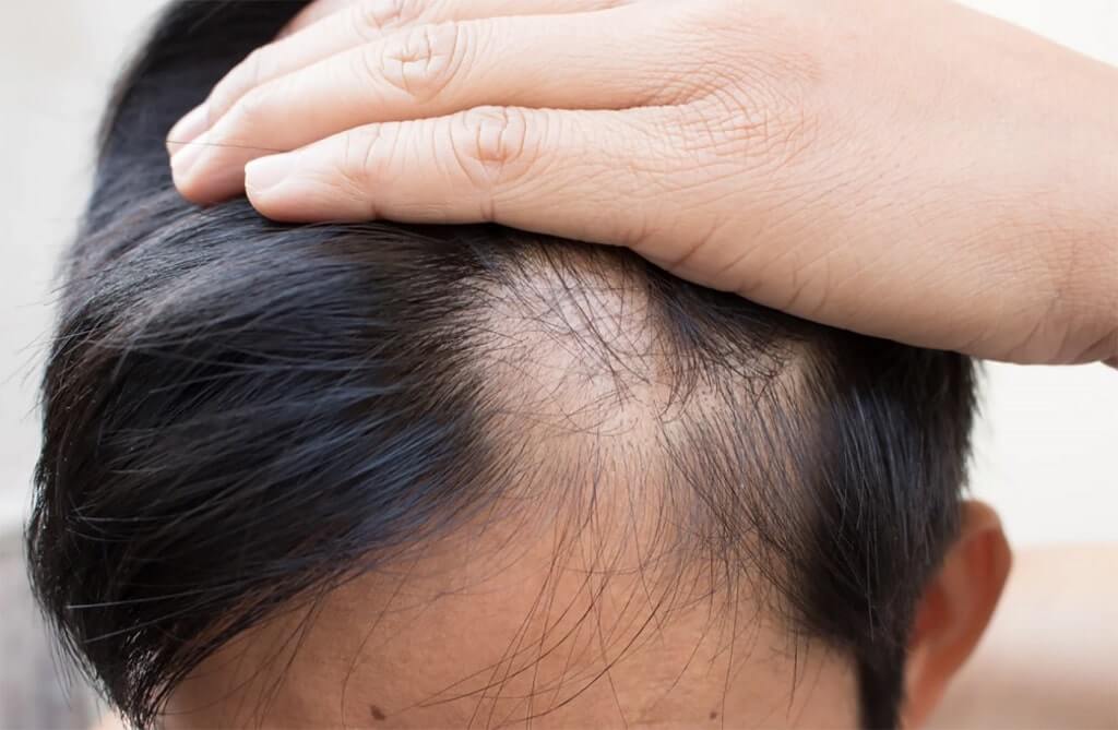 Arthritis Drug Restores Hair in a Third of Alopecia Patients in New Trials