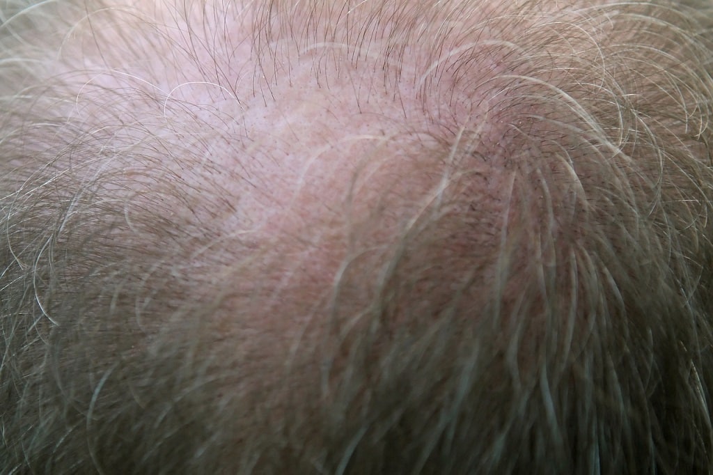 What Is The Process of Laser Hair Regrowth Treatment?