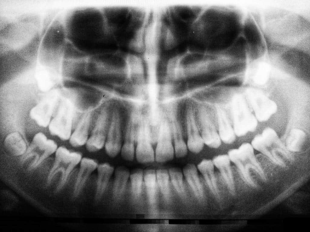 Considering Dental Implants: Here Are 5 Things You Should Know