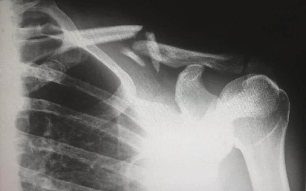 Damages You're Entitled Compensation for in Premises Liability Lawsuit