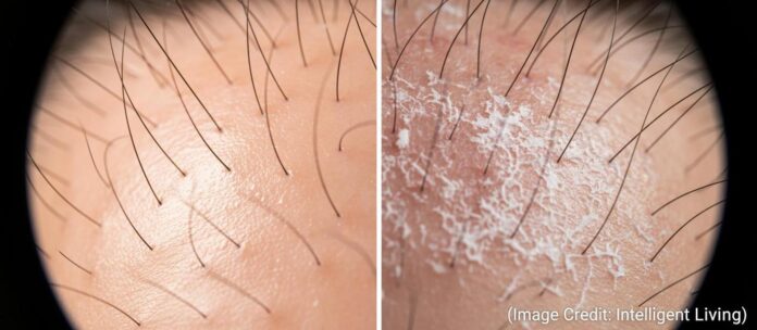 Most consumers assume that any flaking is synonymous with dandruff, yet this common misconception often leads to improper treatment cycles that damage the hair's natural ecosystem.