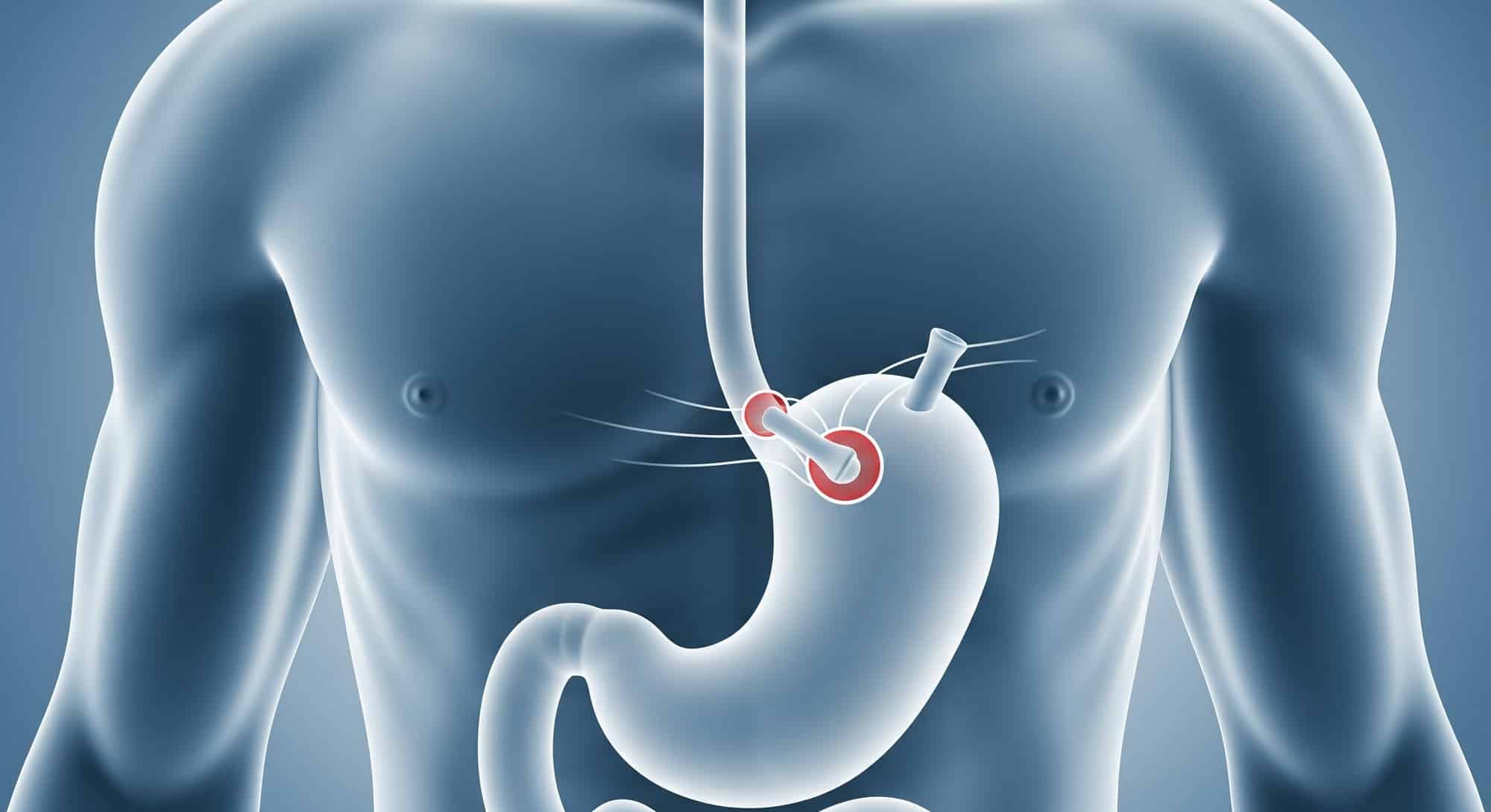 Medical illustration of RefluxStop implant correcting GERD by stabilizing the upper stomach