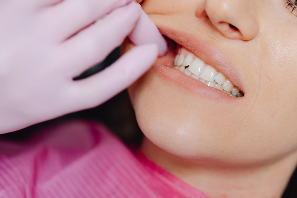 What Causes Gum Recession and How It Affects Oral Health A close-up shot of a person's teeth and lower face, with a gloved hand gently pulling the cheek away to reveal the gum line and dental examination.