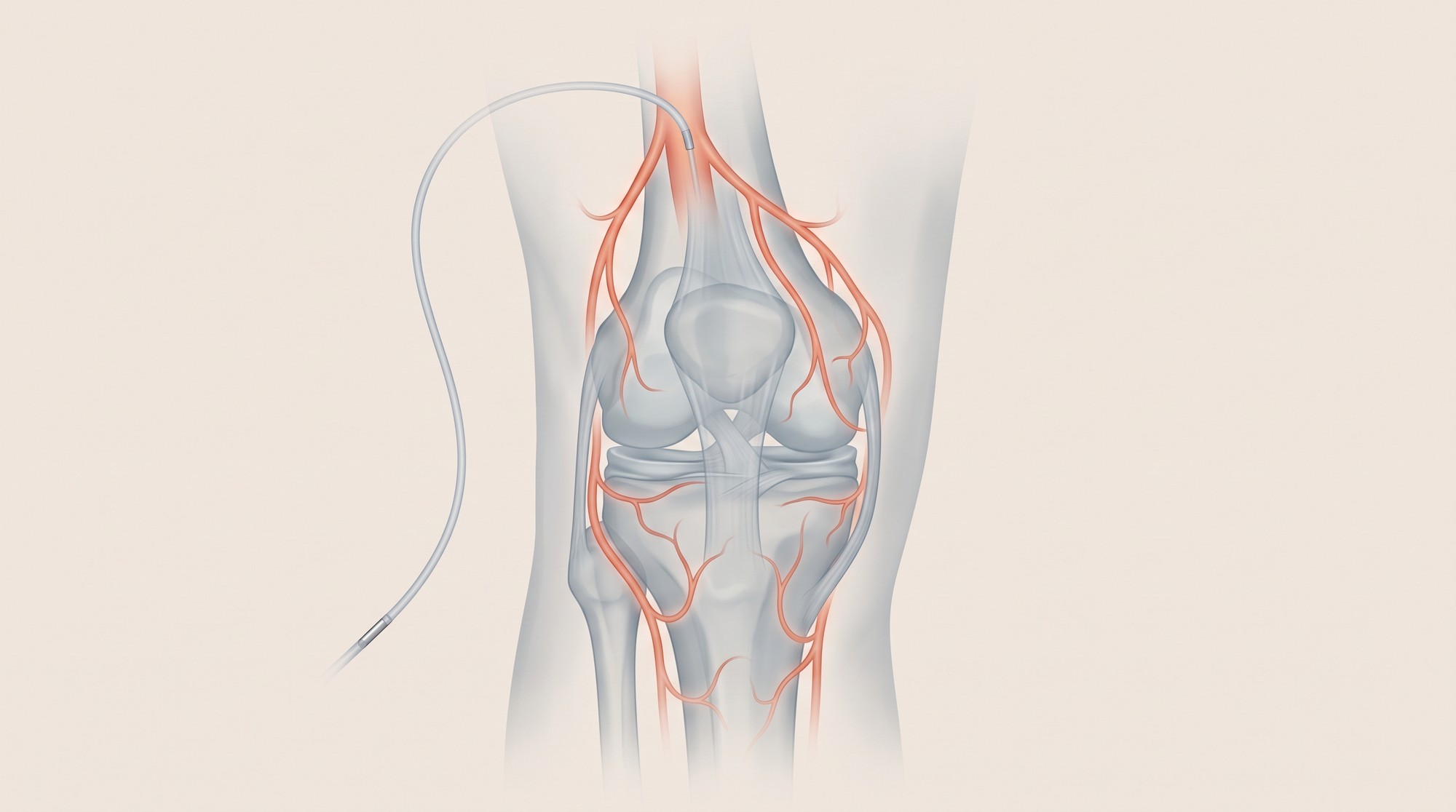 Genicular Artery Embolization for Knee Osteoarthritis: What the Evidence Actually Shows Medical illustration of a knee joint with the genicular arteries highlighted and a catheter approaching the blood vessels