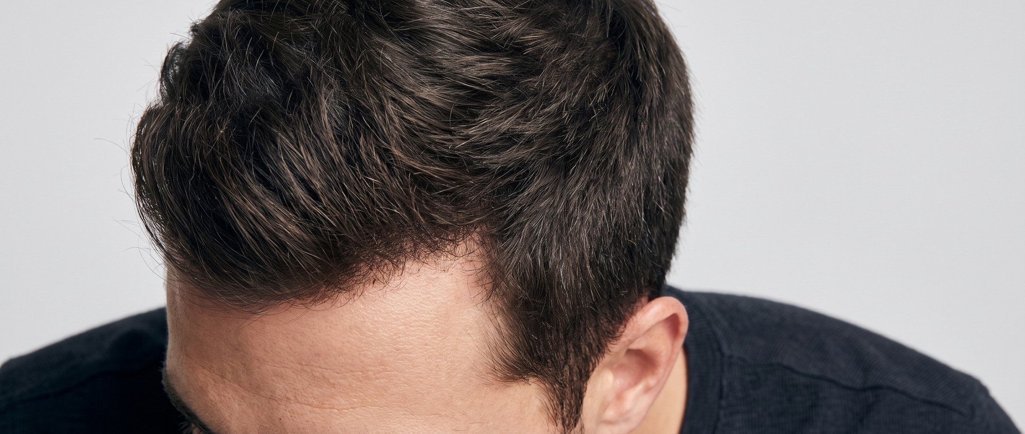 Close-up of a man's healthy hairline and densely packed hair