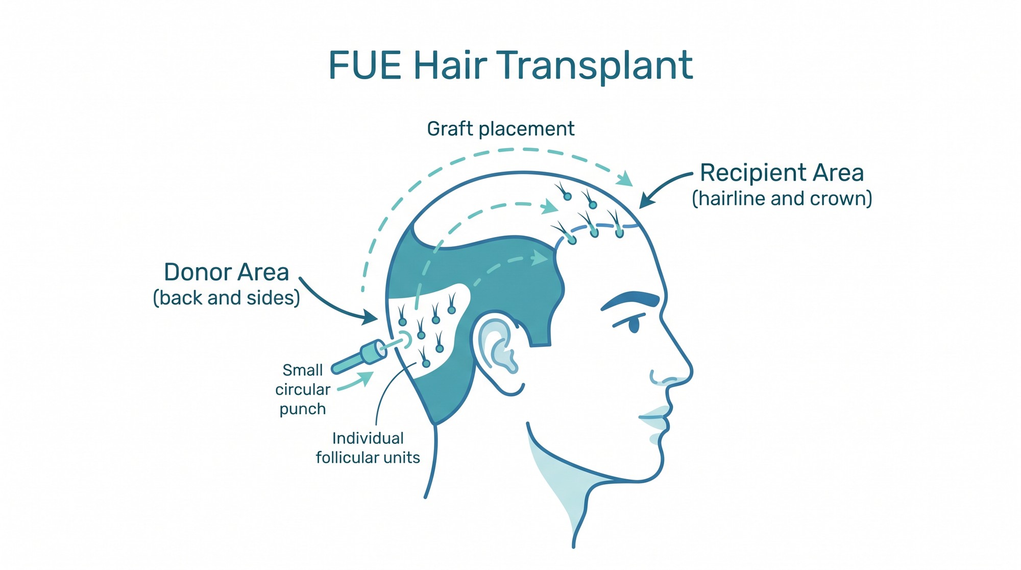 Diagram showing individual follicular units being moved from the donor area to the recipient area during an FUE hair transplant